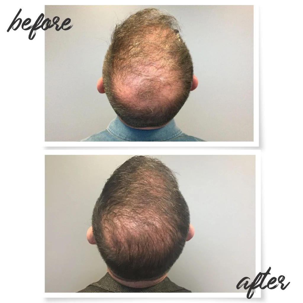 male Neograft before and after