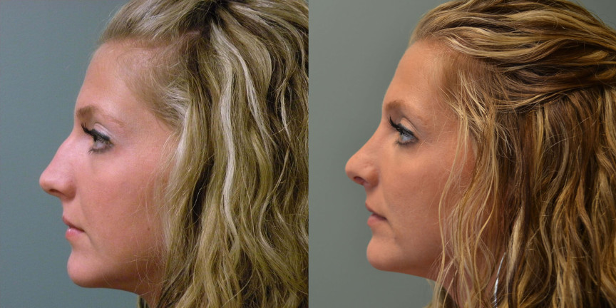 rhinoplasty before and after