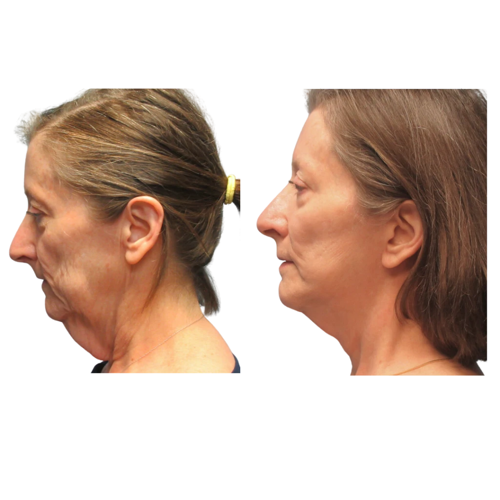 Facelift Surgery Before & After at CAPS